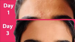 ACNE Treatment At Home  3 day Acne REMOVAL Challenge  Acne Treatment Ayurvedic with Results [upl. by Lrae]