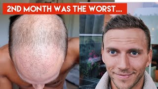 My Hair Transplant Journey  The AWFUL first 4 months indepth walkthrough week by week [upl. by Aiclef659]