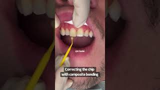 Fixing a chipped front tooth  composite bonding  Cosmetic Dentist Dr Yazdan [upl. by Lavery984]