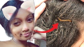 Dandruff Hair treatment  Antipellicule Cheveux  trètman Pou Kap Nan Cheve [upl. by Icrad]