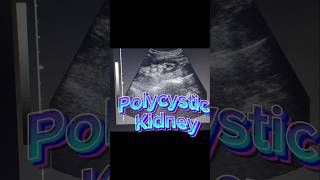 Polycystic Kidneys  Renal Cysts  Kidney Cysts on ultrasound [upl. by Collier]