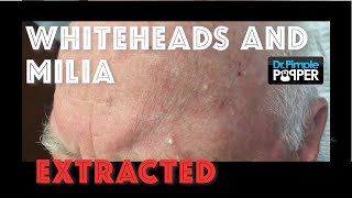 Whiteheads and milia extracted after Mohs surgery [upl. by Alejo]