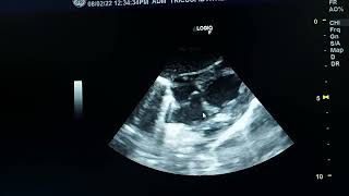 tricuspid atresia echocardiography [upl. by Gram470]