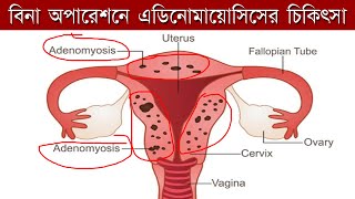 বিনা অপারেশনে এডিনোমায়োসিসের চিকিৎসা। adenomyosis treatment without surgery। adenomyosis bangla [upl. by Delmor]