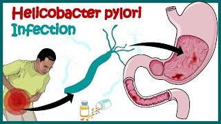 Helicobacter Pylori Infection  Gastric ulcer  Causes Signs and Symptoms Diagnosis and Treatment [upl. by Aniral]