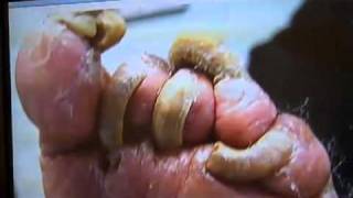 What is a fungal nail infectionMinnesota Podiatrist Explains wwwinnovativefootcarecom [upl. by Kenwee]