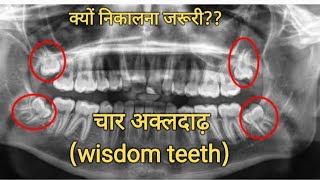 Wisdom Teeth Problems And Solutions [upl. by Tolley]