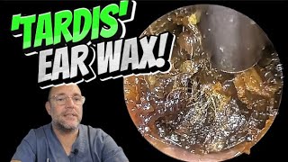 TARDIS EAR WAX 329 ear earwax earwaxremoval asmr satisfying foryou fyp foryourpage [upl. by Nired]