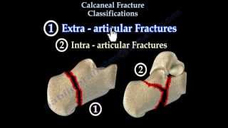 Calcaneal Fracture Classifications  Everything You Need To Know  Dr Nabil Ebraheim [upl. by Bank]