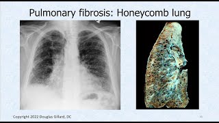 Interstitial Fibrosis amp All About Pathological Auscultatory Breath Sounds Adventitious Sounds [upl. by Carper238]