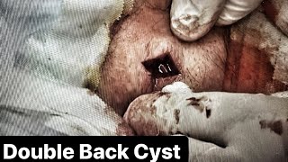 Double Back Cyst Epidermoid Cyst Removal Dr John Gilmore [upl. by Enihpad]