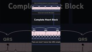 Third Degree Atrioventricular Block ECG QRS complexes [upl. by Neelhtac]