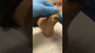 Discover how Aussie podiatrists tackle Forefoot Callus removal FootHealth PodiatryMagic [upl. by Omixam924]