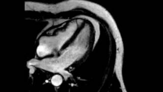 Constrictive pericarditis fourchamber ECGgated cine SSFP MR [upl. by Tyre375]