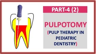 PULPOTOMY PART 42 PULP THERAPY PEDODONTICS PARTIAL PULPOTOMY FORMOCRESOL dentalcafe4331 [upl. by Sonitnatsok]