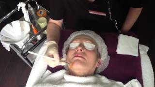 NeoStrata Glycolic Acid Skin Peel UK in Droitwich Clinic Worcestershire [upl. by Selway208]