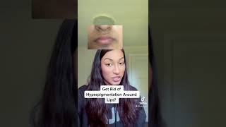 Get Rid Of Hyperpigmentation Around Lips [upl. by Ayotyal]