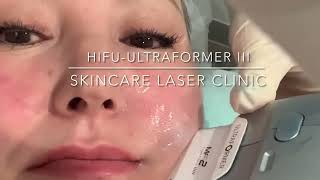 HIFU Treatment  Skincare Laser Clinic  Point Cook Melbourne [upl. by Saibot]