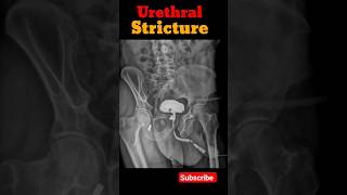 Retrograde urethrogram rgu urethralstricture shorts radiologicalprocedure radiology [upl. by Weld]