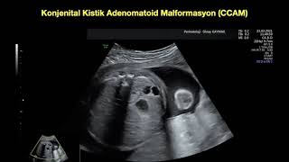 Konjenital kistik adenomatoid malformasyon CCAM tip 1 2 [upl. by Atnuahs]