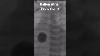 Rashkind procedure Ballon atrial septostomy [upl. by Lowenstern32]