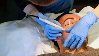 Microdermabrasion with Stuart  The Laser and Skin Clinic [upl. by Merill]