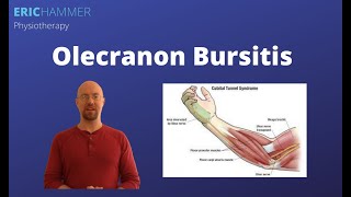 Olecranon Bursitis [upl. by Nawrocki760]