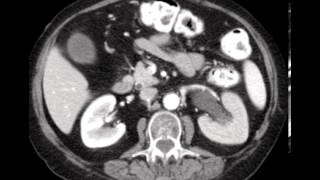 Delayed Nephrogram Stone CASE DISCUSSION by a Radiologist [upl. by Keyser318]