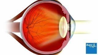 How LASIK eye surgery is carried out [upl. by Beyer]