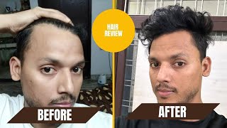 Hair Transformation Before and After Results  Traya Hair Review Hindi  Traya Results [upl. by Law]