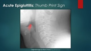 Acute Epiglottitis Thumb Sign [upl. by Ddat181]