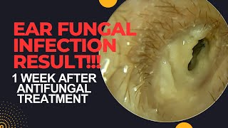 RESULT Of Antifungal Treatment In Otomycosis After 1 WEEK [upl. by Adnalu]