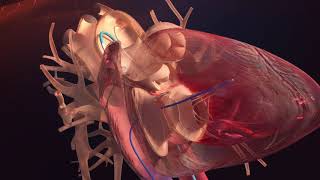 Opération cardiaque en 3D  Cathéter cardiaque [upl. by Dnalyaw]