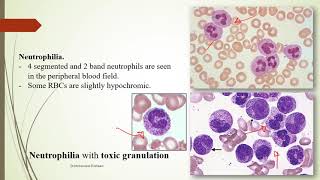 Practical Hematology 11 Morphology of Benign WBCs disorders [upl. by Beverley538]