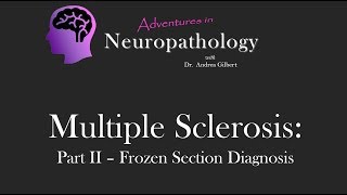 Multiple Sclerosis Part II Frozen Section Diagnosis  Adventures in Neuropathology [upl. by Aelram]