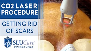 CO2 Laser Resurfacing Treatment For Getting Rid of Scars  Full Procedure [upl. by Dleifrag]