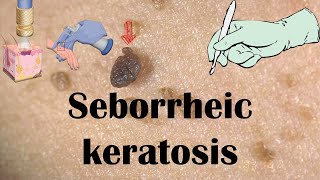 Seborrheic Keratosis Dermatitis Age Spots  Causes Signs amp Symptoms amp Treatment [upl. by Mellisent453]