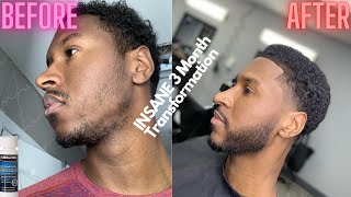 Minoxidil Beard Journey  35 Month Transformation insane minoxidil update [upl. by Senilec]