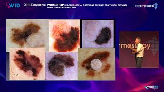 XIII Workshop  G Argenziano  Update diagnosi tumori cutanei [upl. by Mackey]