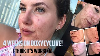 ACNE amp Doxycycline  First 4 weeks  Update [upl. by Anaerdna420]