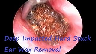 Most Irritating Ear Wax  Deep Impacted Hard Stuck Ear Wax Removal [upl. by Espy141]