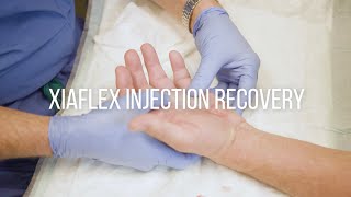 Dupuytrens Contracture Injection Recovery Instructions [upl. by Rehpotsrik]