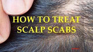 HOW TO TREAT SCALP SCABS [upl. by Janot]