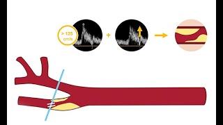 Identifying carotid artery disease with ultrasound [upl. by Etteloiv]