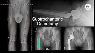 Anterior Approach Subtrochanteric Osteotomy [upl. by Attevroc]