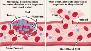 Von Willebrand disease [upl. by Kimberly581]