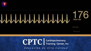 Taquicardia Supraventricular [upl. by Nylsej]