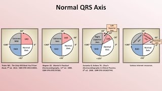 Intro to EKG Interpretation  Rate and Axis [upl. by Imoan753]