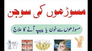 Masooron ki sujan ka ilaj  Pyorrhea treatment at home Urdu  Pyorrhoea ka gharelu ilaj [upl. by Orofselet]