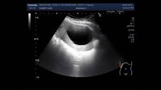 Hydatid Hepatic Cyst [upl. by Morrison]